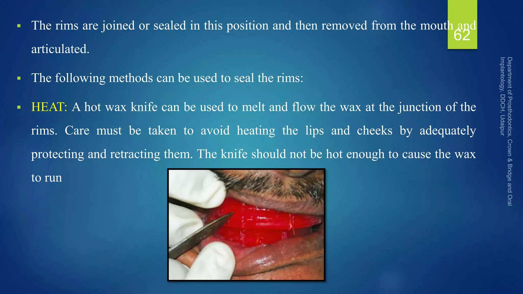  The rims are joined or sealed in this position and then removed from the mouth and
articulated.
 The following methods can be used to seal the rims:
 HEAT: A hot wax knife can be used to melt and flow the wax at the junction of the
rims. Care must be taken to avoid heating the lips and cheeks by adequately
protecting and retracting them. The knife should not be hot enough to cause the wax
to run
62
 