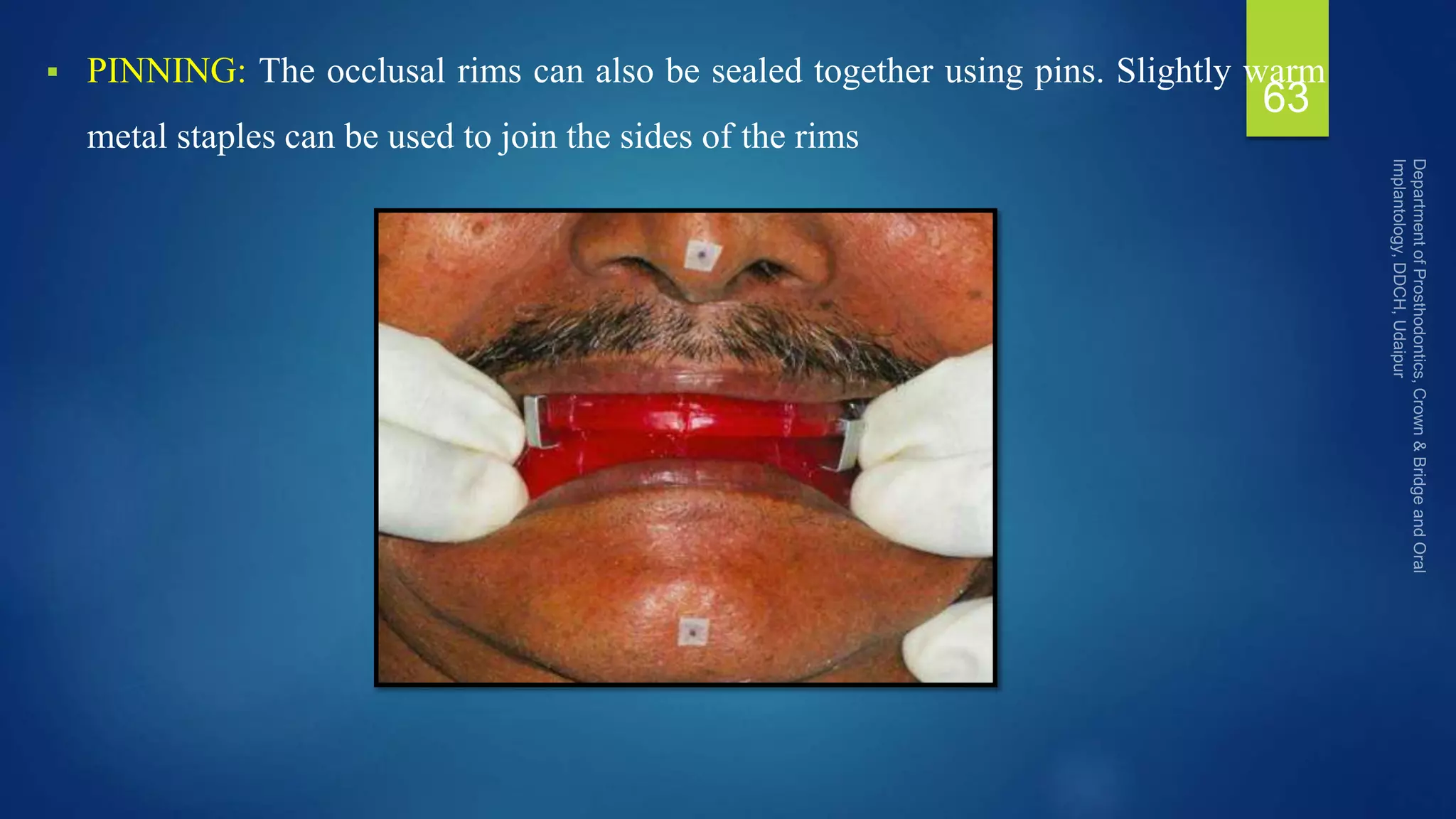  PINNING: The occlusal rims can also be sealed together using pins. Slightly warm
metal staples can be used to join the sides of the rims
63
 