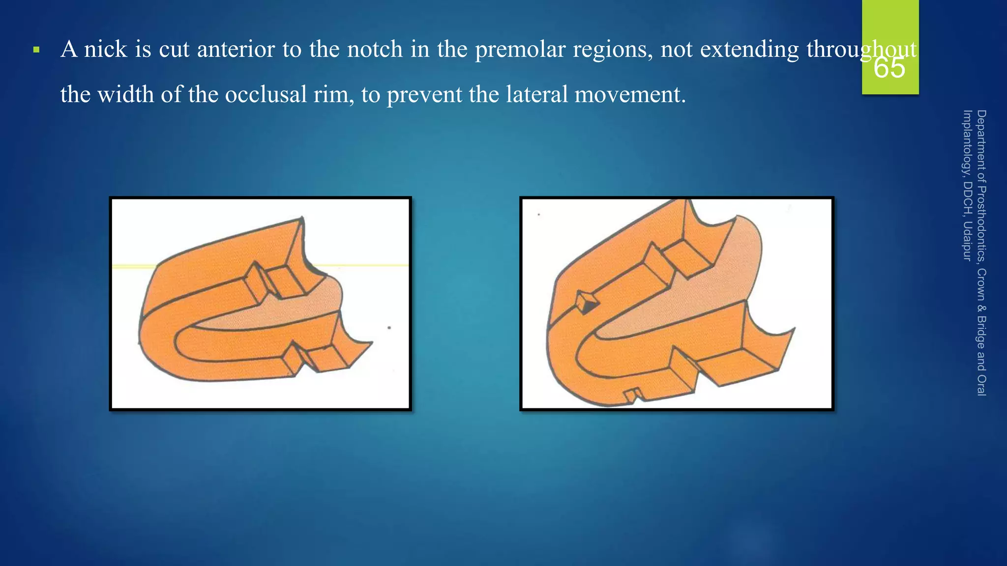  A nick is cut anterior to the notch in the premolar regions, not extending throughout
the width of the occlusal rim, to prevent the lateral movement.
65
 