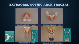 EXTRAORAL GOTHIC ARCH TRACERS.
CENTRAL BEARING PLATE. CENTRAL BEARING POINT.
STYLUS/SCRIBER POINT. TRACING PLATE/PLATFORM.
 
