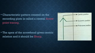 • Characteristic pattern created on the
recording plate is called a central Arrow
point tracing.
• The apex of the arrowhead gives centric
relation and it should be Sharp.
 