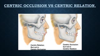 CENTRIC OCCLUSION VS CENTRIC RELATION.
 