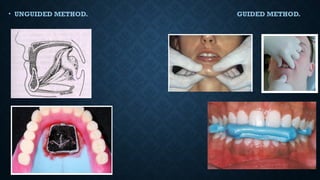 • UNGUIDED METHOD. GUIDED METHOD.
 