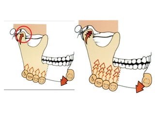 to find and verify centric relation or adapted
FIGURE 9-1 Testing position and alignment of each con
begin with gentle loading. B, Thumbs and fingers load the
ward and forward direction.
B
 