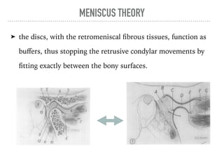 MENISCUS THEORY
➤ the discs, with the retromeniscal fibrous tissues, function as
buﬀers, thus stopping the retrusive condylar movements by
fitting exactly between the bony surfaces.
olume 26
Number 6
Centric relation and condylar mouement 585
Fig. 4. The temporomandibular articulation in centric relation, sagittal section (semischematic).
(I) Condyle, (2) compact disc, (3, 3’) external pterygoid muscle, (4) temporal bone,
(5) upper articular cavity and (5’) its posterior fold, (6) fib rous posterior disc and (6’) fibrous
anterior disc, (7) retroarticular fibrous tissue, (8) lower cavity and (8’) its anterior fold,
(9) external acoustic conduct, (10) parotid gland, (:I) superficial temporal artery, (22)
auriculotemporal nerve, (I 3) cortex.
Volume 26
Number 6
Centric relation and condylar movement
Fig. 7. Sagittal section of the temporomandibular articulation represented in Fig. 4,
pulsive gliding position. See Fig. 4 for the rest shape of the disc, cavities, and pre- and
articular tissues. Line from center of condyle backward shows condylar path. An a
separation is shown between the fascicles of the external pterygoid to show that the
one is descended. (A) Retroarticular tissues are unfolded; (B) posterior fold of upper
has disappeared; (C) posterior propulsive fold of lower cavity is initiated; (D) disc a
 