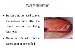 STAPLER PIN METHOD
➤ Stapler pins are used to seal
the occlusal rims after the
centric relation are being
registered.
➤ Limitation: Centric relation
record cannot be verified.
 
