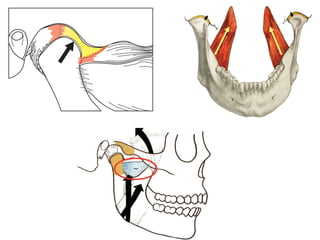k are properly aligned (Figure 7-7), all loading (compres-
e) forces are directed through avascular, noninnervated
uctures that were designed to accept loading. Sicher,9
in
classic text on anatomy, The Temporomandibular Joint,
2, cites this as proof that the TMJs are load-bearing joints.
GURE 7-7 Note also that around the disk there are vascularized tis-
with copious innervation. If the disk becomes misaligned, the loading
es are directed through highly vascularized and innervated tissues that
ond with pain or discomfort. This is why load testing of the TMJs is an
ortant step in determination of centric relation. This is one of the rea-
the TMJs are not in centric relation if they cannot accept firm loading
complete comfort.
C
It is a mistak
placement of the
consistent experi
often the trigger
In fact, some of t
sult from deflect
loose interfering
relation to maxi
many less than s
cause minute inte
perfecting any o
!
FIGURE 7-17 Medial pole bracing in line with internal pterygoid mu
cle contraction establishes the midmost position at centric relation.
 