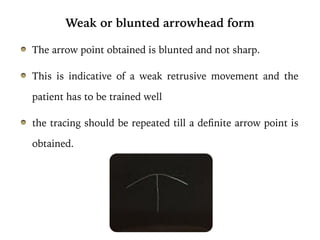The arrow point obtained is blunted and not sharp.
This is indicative of a weak retrusive movement and the
patient has to be trained well
the tracing should be repeated till a definite arrow point is
obtained.
by Gothic arch tracing should be 120 degrees indicating the health of
Temporomandibular joint without interferences in the path of condylar
movement and balanced neuromuscular coordination. The bilateral
symmetrical form of arrowhead depicts the undisturbed movement of the
condyle in the fossa and slope of eminence.
Classical flat arrowhead form: It is almost similar to classical arrow
point except that the tracing obtained is more than 120°. It has obtuse
left and right lateral tracings. This type of tracing signifies a marked
lateral movement of the condyle in the fossa.
limited mandibular mo
neuromuscular coordina
improper seating of record
edentulous for longer per
Extended arrowhead
mandibular movement ex
The guidance provided to m
movement of the lower jaw
is also sometimes an artef
record bases or backward
rim while removing them f
repeated to confirm the er
bases and also
Double Arrow Point
It is a record with do
caused due to habitu
Weak or blunted arrowhead form
 
