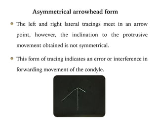 The left and right lateral tracings meet in an arrow
point, however, the inclination to the protrusive
movement obtained is not symmetrical.
This form of tracing indicates an error or interference in
forwarding movement of the condyle.
Classical flat arrowhead form: It is almost similar to classical arrow
point except that the tracing obtained is more than 120°. It has obtuse
left and right lateral tracings. This type of tracing signifies a marked
lateral movement of the condyle in the fossa.
Weak or blunted arrowhead form: The arrow point obtained is
blunted and not sharp the tracing should be repeated till a definite
arrow point is obtained. The patient has to be trained well
Extended arrowhead
mandibular movement e
The guidance provided to
movement of the lower ja
is also sometimes an arte
record bases or backwar
rim while removing them
repeated to confirm the e
bases and also
Double Arrow Point
It is a record with d
caused due to habi
retruded centric r
neuromuscular movem
and guided well.
Interrupted Gothic A
Break-in continuity of
obtained, due to interf
caused due to touchin
lateral movements.
Atypical Form
The component does n
the lateral paths. This
of a faulty Muscular p
like bruxism. It is a
Asymmetrical arrowhead form
 