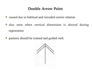 Double Arrow Point
caused due to habitual and retruded centric relation
also seen when vertical dimension is altered during
registration
patients should be trained and guided well.
 