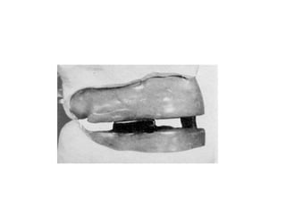 Fig. 2. Physiologic vertical dimension is recorded by an
anterior record made in a cone of soft wax. Repeated
swallowing of saliva establishes the height of the wax at the
physiologic vertical dimension.
Fig. 3. Physiologic centric relation record is made in soft wax
at the physiologic vertical dimension.
Fig. 5. Thir
premature
wax, which
 