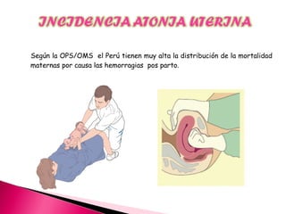 Según la OPS/OMS el Perú tienen muy alta la distribución de la mortalidad
maternas por causa las hemorragias pos parto.
 
