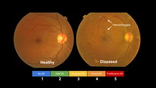 Healthy Diseased
Hemorrhages
No DR Mild DR Moderate DR Severe DR Proliferative DR
1 2 3 4 5
 