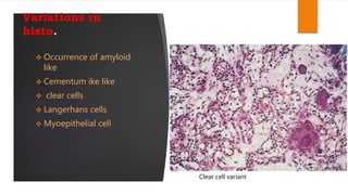 calcifying epithelial odontogenic tumor Ceot | PPTX