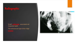 calcifying epithelial odontogenic tumor Ceot | PPTX