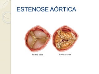 ESTENOSE AÓRTICA
 