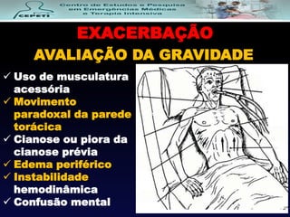 EXACERBAÇÃO
AVALIAÇÃO DA GRAVIDADE
 Uso de musculatura
acessória
 Movimento
paradoxal da parede
torácica
 Cianose ou piora da
cianose prévia
 Edema periférico
 Instabilidade
hemodinâmica
 Confusão mental
 