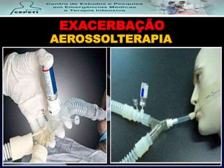 EXACERBAÇÃO
AEROSSOLTERAPIA
 