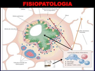 FISIOPATOLOGIA
 