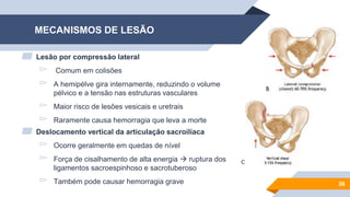 MECANISMOS DE LESÃO
▰ Lesão por compressão lateral
▻ Comum em colisões
▻ A hemipélve gira internamente, reduzindo o volume
pélvico e a tensão nas estruturas vasculares
▻ Maior risco de lesões vesicais e uretrais
▻ Raramente causa hemorragia que leva a morte
▰ Deslocamento vertical da articulação sacroilíaca
▻ Ocorre geralmente em quedas de nível
▻ Força de cisalhamento de alta energia  ruptura dos
ligamentos sacroespinhoso e sacrotuberoso
▻ Também pode causar hemorragia grave 36
 