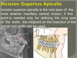Tooth Bisection Cephalometic | PPTX