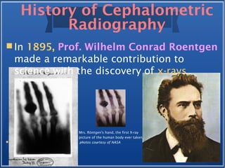 History of Cephalometric
Radiography
 In 1895, Prof. Wilhelm Conrad Roentgen
made a remarkable contribution to
science with the discovery of x-rays.
Mrs. Röntgen's hand, the first X-ray
picture of the human body ever taken.
 photos courtesy of NASA
 