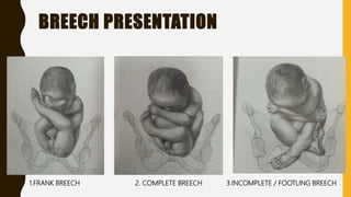 cephalic presentation slideshare