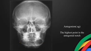 Antegonion( ag)
The highest point in the
antegonial notch
 
