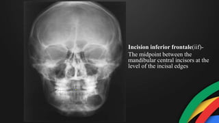Incision inferior frontale(iif)-
The midpoint between the
mandibular central incisors at the
level of the incisal edges
 