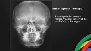 The midpoint between the
maxillary central incisors at the
level of the incisal edges
Incision superior frontale(isf)
 