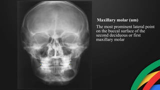 The most prominent lateral point
on the buccal surface of the
second deciduous or first
maxillary molar
Maxillary molar (um)
 