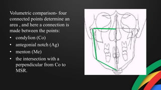 Volumetric comparison- four
connected points determine an
area , and here a connection is
made between the points:
• condylion (Co)
• antegonial notch (Ag)
• menton (Me)
• the intersection with a
perpendicular from Co to
MSR.
 