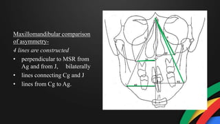 Maxillomandibular comparison
of asymmetry-
4 lines are constructed
• perpendicular to MSR from
Ag and from J, bilaterally
• lines connecting Cg and J
• lines from Cg to Ag.
 
