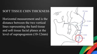 SOFT TISSUE CHIN THICKNESS
Horizontal measurement and is the
distance between the two vertical
lines representing the hard tissue
and soft tissue facial planes at the
level of suprapogonion (10-12mm)
 