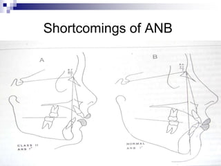 CEPHALOMETRIC ANALYSIS.ppt