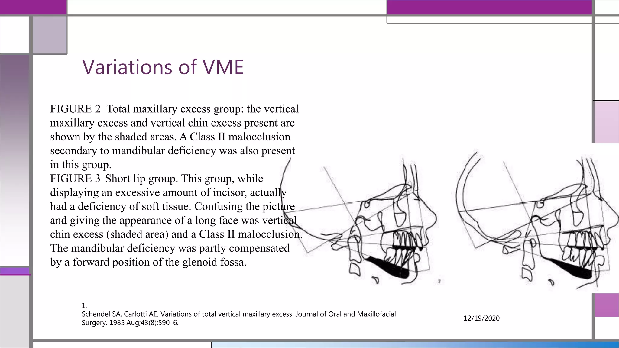 Variations of VME
1.
Schendel SA, Carlotti AE. Variations of total vertical maxillary excess. Journal of Oral and Maxillofacial
Surgery. 1985 Aug;43(8):590–6.
12/19/2020
FIGURE 2 Total maxillary excess group: the vertical
maxillary excess and vertical chin excess present are
shown by the shaded areas. A Class II malocclusion
secondary to mandibular deficiency was also present
in this group.
FIGURE 3 Short lip group. This group, while
displaying an excessive amount of incisor, actually
had a deficiency of soft tissue. Confusing the picture
and giving the appearance of a long face was vertical
chin excess (shaded area) and a Class II malocclusion.
The mandibular deficiency was partly compensated
by a forward position of the glenoid fossa.
 