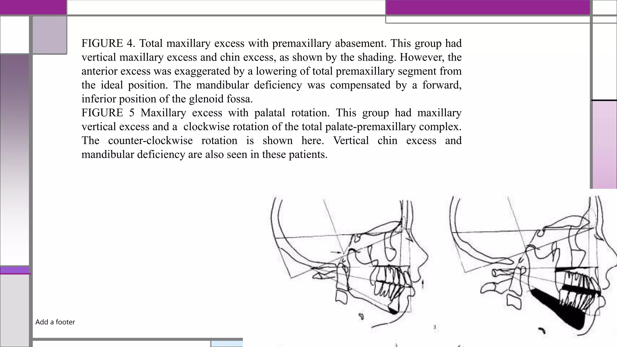 Add a footer
12/19/2020
FIGURE 4. Total maxillary excess with premaxillary abasement. This group had
vertical maxillary excess and chin excess, as shown by the shading. However, the
anterior excess was exaggerated by a lowering of total premaxillary segment from
the ideal position. The mandibular deficiency was compensated by a forward,
inferior position of the glenoid fossa.
FIGURE 5 Maxillary excess with palatal rotation. This group had maxillary
vertical excess and a clockwise rotation of the total palate-premaxillary complex.
The counter-clockwise rotation is shown here. Vertical chin excess and
mandibular deficiency are also seen in these patients.
 