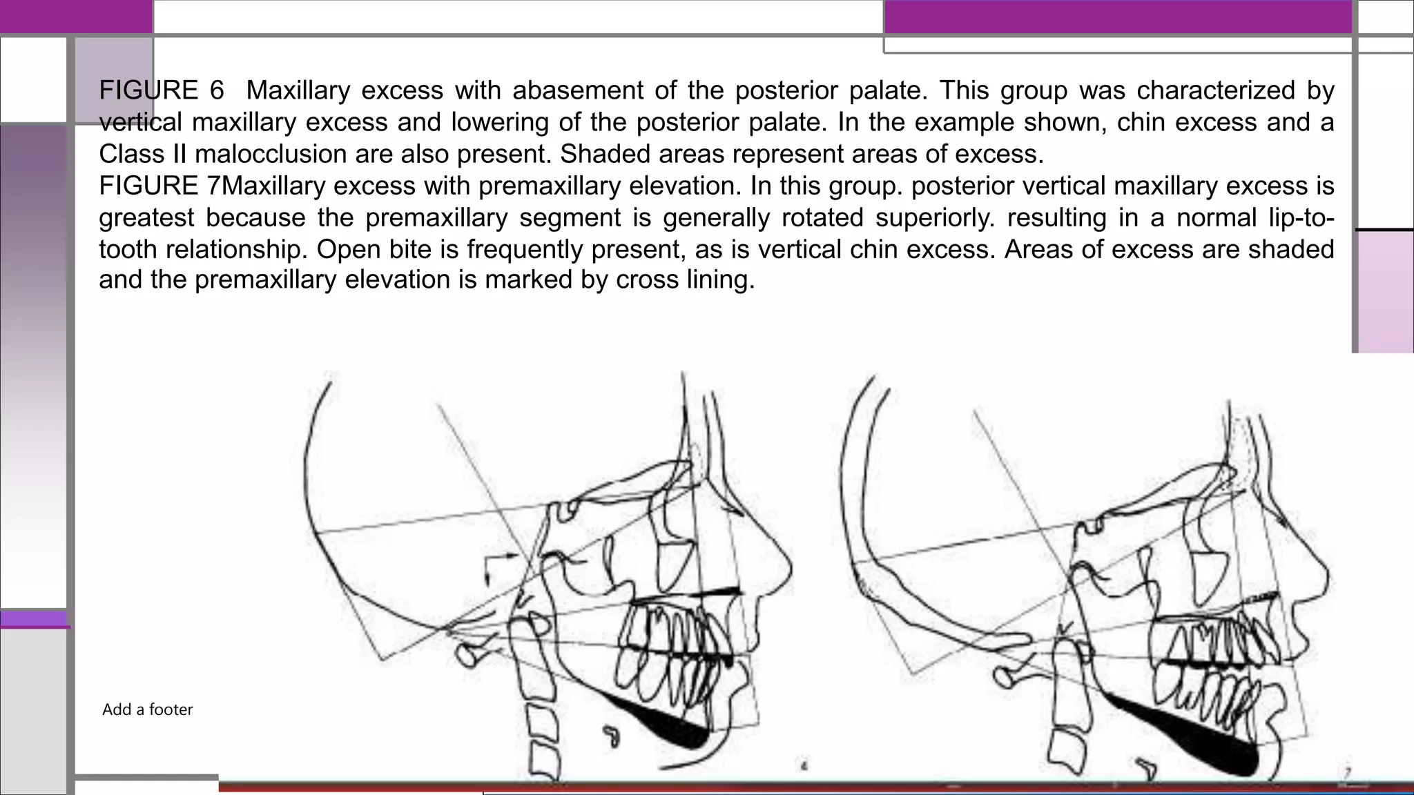 12/19/2020
FIGURE 6 Maxillary excess with abasement of the posterior palate. This group was characterized by
vertical maxillary excess and lowering of the posterior palate. In the example shown, chin excess and a
Class II malocclusion are also present. Shaded areas represent areas of excess.
FIGURE 7Maxillary excess with premaxillary elevation. In this group. posterior vertical maxillary excess is
greatest because the premaxillary segment is generally rotated superiorly. resulting in a normal lip-to-
tooth relationship. Open bite is frequently present, as is vertical chin excess. Areas of excess are shaded
and the premaxillary elevation is marked by cross lining.
Add a footer
 