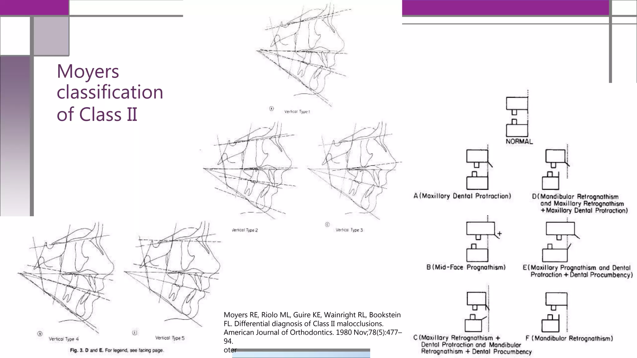 Moyers
classification
of Class II
12/19/2020
Moyers RE, Riolo ML, Guire KE, Wainright RL, Bookstein
FL. Differential diagnosis of Class II malocclusions.
American Journal of Orthodontics. 1980 Nov;78(5):477–
94.
oter
 