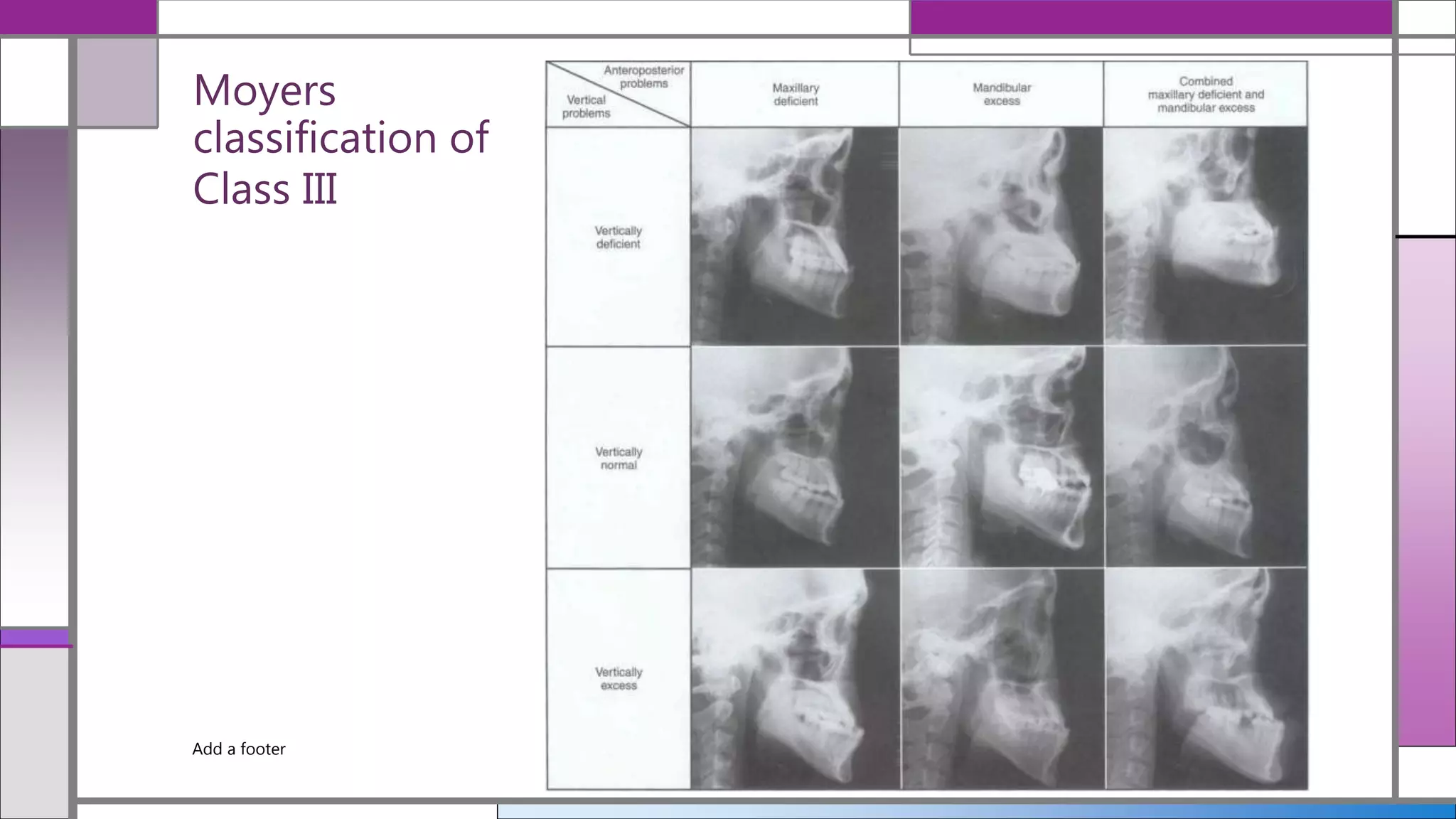 Moyers
classification of
Class III
Add a footer 12/19/2020
 