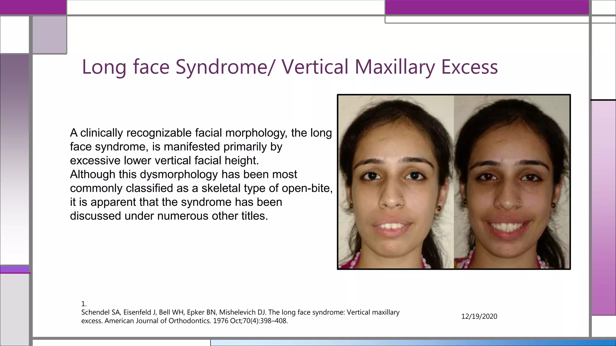 Long face Syndrome/ Vertical Maxillary Excess
1.
Schendel SA, Eisenfeld J, Bell WH, Epker BN, Mishelevich DJ. The long face syndrome: Vertical maxillary
excess. American Journal of Orthodontics. 1976 Oct;70(4):398–408.
12/19/2020
A clinically recognizable facial morphology, the long
face syndrome, is manifested primarily by
excessive lower vertical facial height.
Although this dysmorphology has been most
commonly classified as a skeletal type of open-bite,
it is apparent that the syndrome has been
discussed under numerous other titles.
 