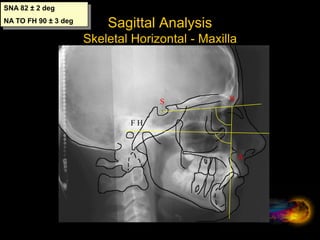 Sagittal Analysis
Maxilla To Mandible
N
A
B
ANB 2 ± 2 deg
 