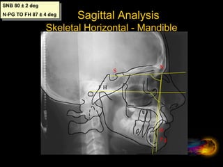 Sagittal Analysis
Maxilla and Mandible
N
A
B
Wit’s Analysis 0-2mm
 