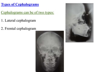 CEPHALOMETRICS(Dr.ASWIN) | PPT