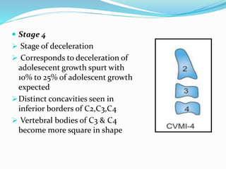 Stage 4
 Stage of deceleration
 Corresponds to deceleration of
adolesecent growth spurt with
10% to 25% of adolescent growth
expected
Distinct concavities seen in
inferior borders of C2,C3,C4
 Vertebral bodies of C3 & C4
become more square in shape
 