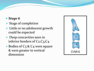  Stage 6
 Stage of completion
 Little or no adolescent growth
could be expected
 Deep concavities seen in
inferior borders of C2,C3,C4
Bodies of C3 & C4 were square
& were greater in vertical
dimension
 
