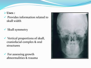  Uses :
 Provides information related to
skull width
 Skull symmetry
 Vertical proportions of skull,
craniofacial complex & oral
structures
 For assessing growth
abnormalities & trauma
 