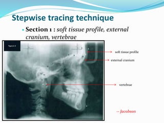 Stepwise tracing technique
 Section 1 : soft tissue profile, external
cranium, vertebrae
soft tissue profile
external cranium
vertebrae
-- Jacobson
 