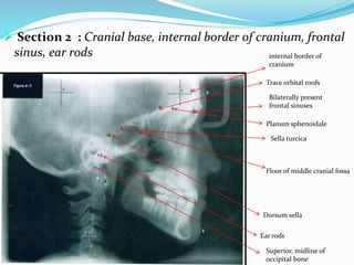  Section 2 : Cranial base, internal border of cranium, frontal
sinus, ear rods internal border of
cranium
Trace orbital roofs
Sella turcica
Planum sphenoidale
Bilaterally present
frontal sinuses
Dorsum sella
Superior, midline of
occipital bone
Floor of middle cranial fossa
Ear rods
 