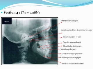  Section 4 : The mandible
Anterior border, symphysis
Marrow space of symphysis
Inferior border of mandible
Posterior aspect of rami
Mandibular condyles
Mandibular notches & coronoid process
Anterior aspect of rami
Mandibular first molars
Mandibular incisors
 